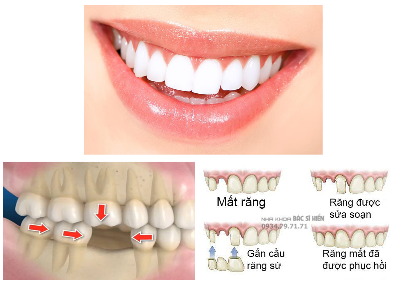 Mất răng có nguy hiểm không ? - Nha Khoa Bác Sĩ Hiển